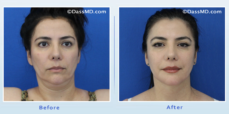 Dr. Dennis Dass, Facial fat grafting