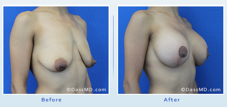 Breast Augmentation with Lift case 7 before after image 2