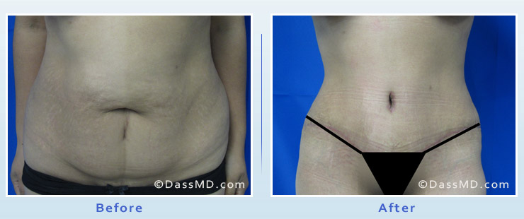 Dr. Dennis Dass, MD Tummy Tuck image