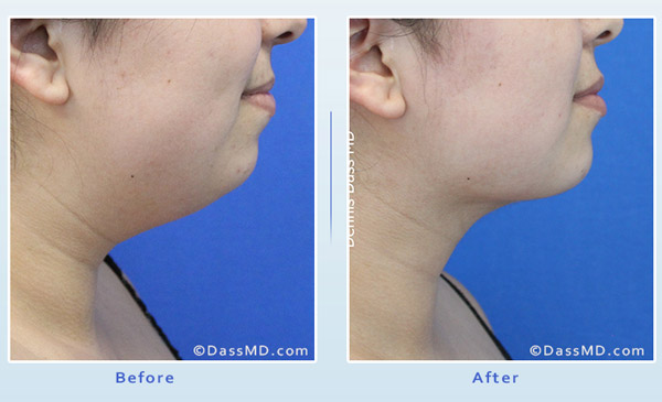 Dr. Dennis Dass, MD Chin Liposuction