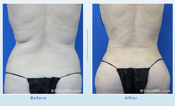 Dr. Dennis Dass, MD Back Liposuction