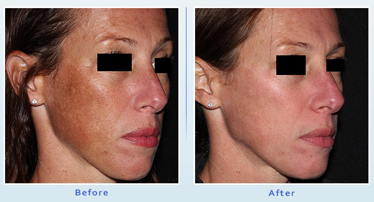 PicoFacial treatment before and after 2