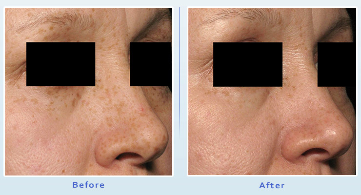 Brown spot treatment results before and after 1