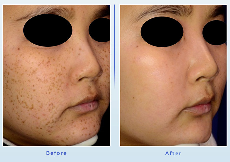 Brown spot treatment results before and after 2