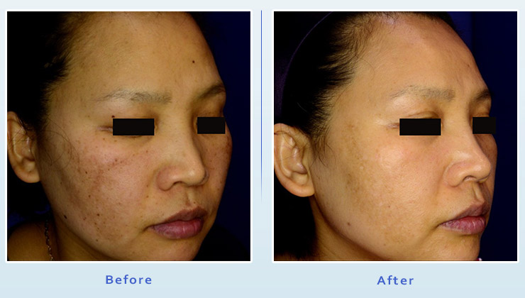 Brown spot treatment results before and after 3