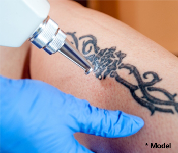 Laser tattoo removal