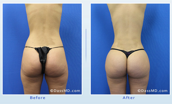 Dr. Dennis Dass, MD Thigh Liposuction